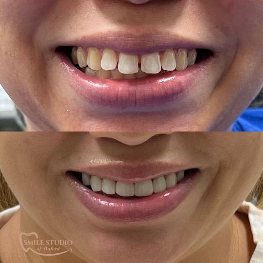 Porcelain Veneers