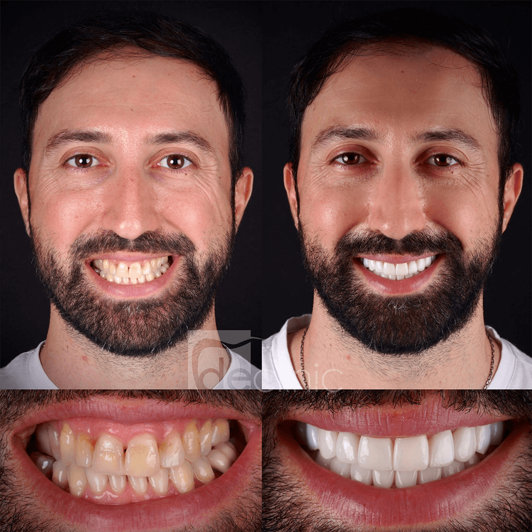 Complete Smile Makeover 